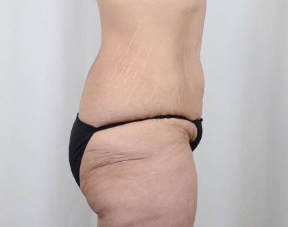 Tummy Tuck Before & After Patient #221
