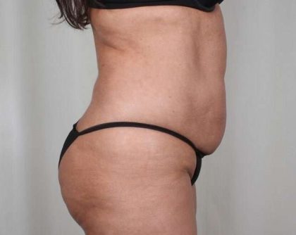 Tummy Tuck Before & After Patient #231