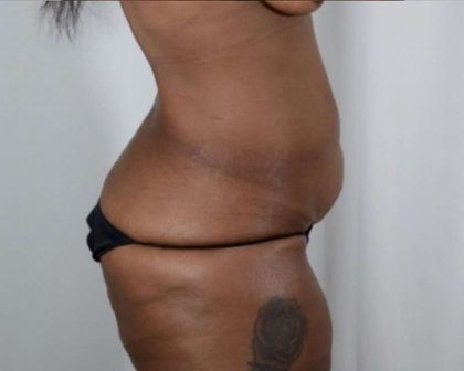 Tummy Tuck Before & After Patient #251