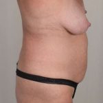 Tummy Tuck Before & After Patient #261