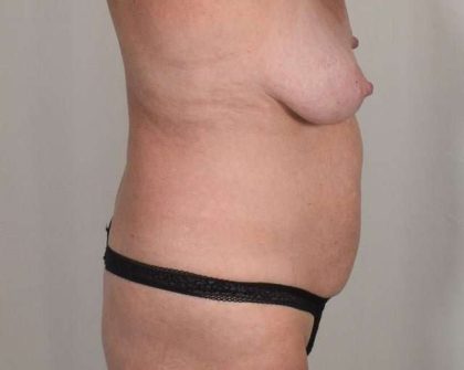 Tummy Tuck Before & After Patient #261