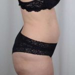Tummy Tuck Before & After Patient #271