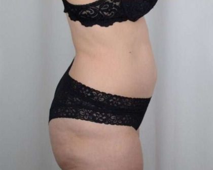 Tummy Tuck Before & After Patient #271