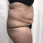 Tummy Tuck Before & After Patient #276