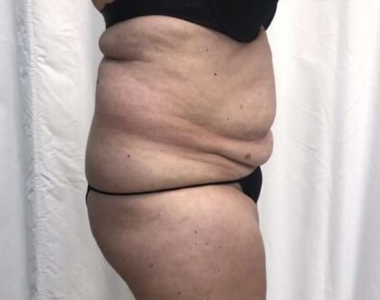 Tummy Tuck Before & After Patient #276