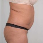 Tummy Tuck Before & After Patient #281