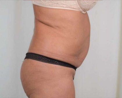 Tummy Tuck Before & After Patient #281