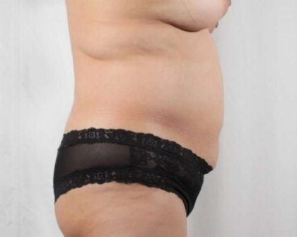 Tummy Tuck Before & After Patient #286