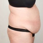 Tummy Tuck Before & After Patient #291