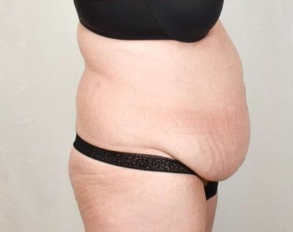 Tummy Tuck Before & After Patient #291