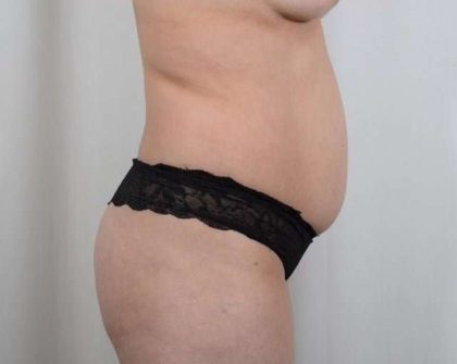 Tummy Tuck Before & After Patient #296