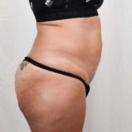 Tummy Tuck Before & After Patient #301