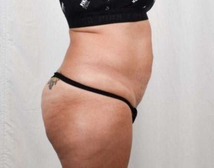 Tummy Tuck Before & After Patient #301
