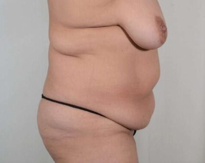 Tummy Tuck Before & After Patient #306