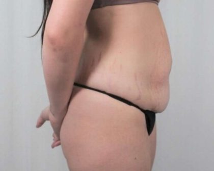 Tummy Tuck Before & After Patient #311