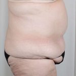 Tummy Tuck Before & After Patient #316