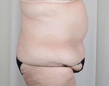 Tummy Tuck Before & After Patient #316