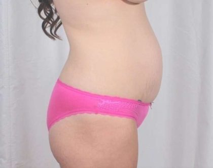 Tummy Tuck Before & After Patient #321