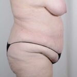 Tummy Tuck Before & After Patient #326