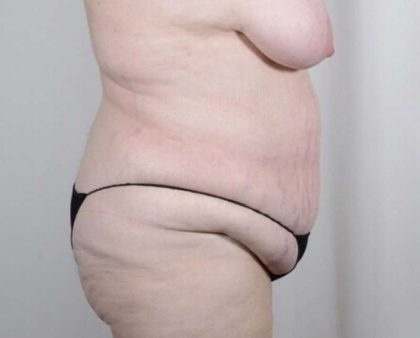 Tummy Tuck Before & After Patient #326