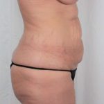 Tummy Tuck Before & After Patient #331