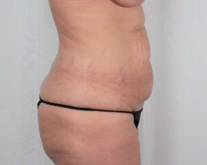 Tummy Tuck Before & After Patient #331