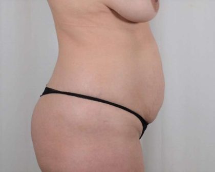Tummy Tuck Before & After Patient #336