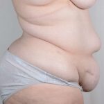 Tummy Tuck Before & After Patient #341
