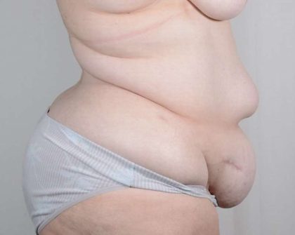 Tummy Tuck Before & After Patient #341