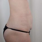 Tummy Tuck Before & After Patient #346