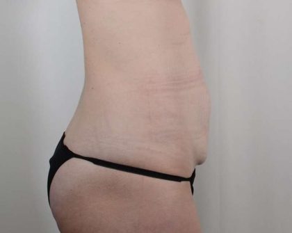Tummy Tuck Before & After Patient #346