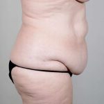 Tummy Tuck Before & After Patient #351