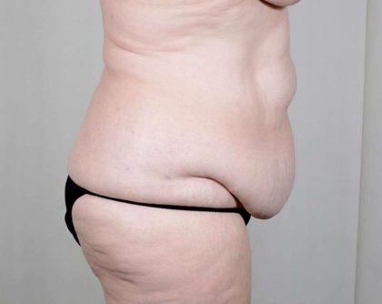 Tummy Tuck Before & After Patient #351