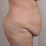 Tummy Tuck Before & After Patient #356
