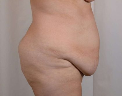 Tummy Tuck Before & After Patient #356