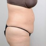 Tummy Tuck Before & After Patient #361