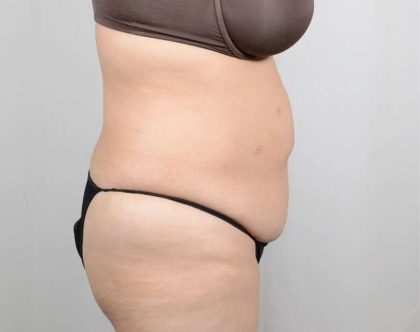 Tummy Tuck Before & After Patient #361
