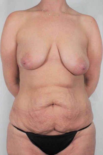 Mommy Makeover Before & After Patient #391