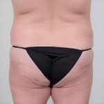 Brazilian Butt Lift Before & After Patient #418
