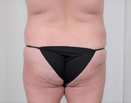 Brazilian Butt Lift Before & After Patient #418