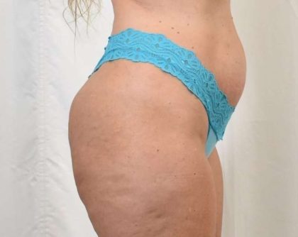 Brazilian Butt Lift Before & After Patient #423
