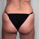 Brazilian Butt Lift Before & After Patient #428