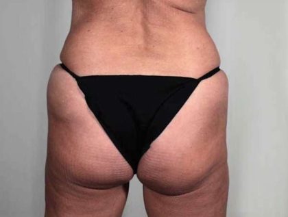 Brazilian Butt Lift Before & After Patient #428