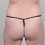 Brazilian Butt Lift Before & After Patient #433