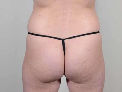 Brazilian Butt Lift Before & After Patient #433