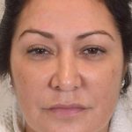 Liposuction Before & After Patient #438