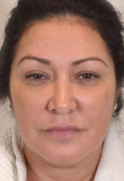 Liposuction Before & After Patient #438