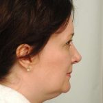 Liposuction Before & After Patient #441