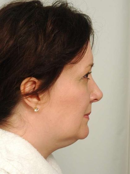 Liposuction Before & After Patient #441