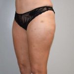 Liposuction Before & After Patient #448